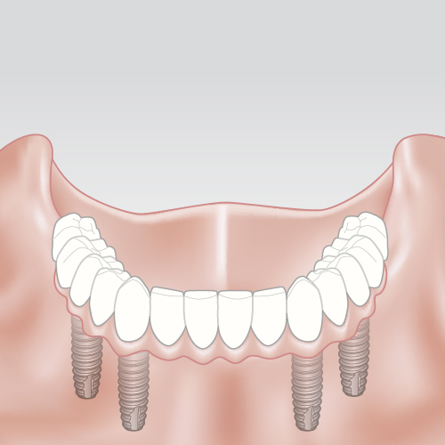 Neišimamas (fiksuotas) protezas ant 4 implantų