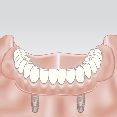 Išimamas protezas ant dviejų implantų